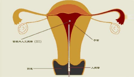 温州试管婴儿医院